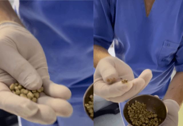 Imagem da noticia Médico retira 35 pedras da bexiga de homem que bebia refrigerante todo dia; entenda riscos