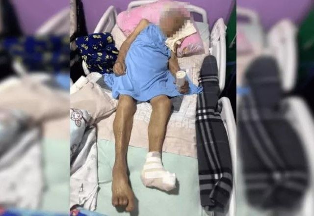 Imagem da noticia Idosa de 103 anos tem pé amputado sem anestesia em cirurgia realizada por enfermeira