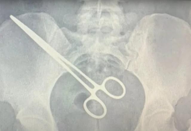 Imagem da noticia Mulher passa dois meses com pinça cirúrgica esquecida no abdômen