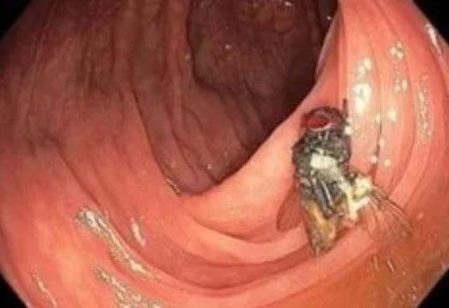 Imagem da noticia Médicos encontram mosca viva dentro de intestino de paciente durante exame