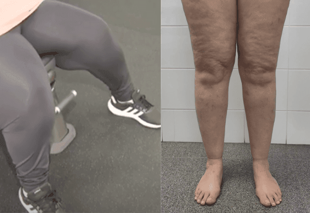 Imagem da noticia Você pode ter lipedema e não saber; entenda