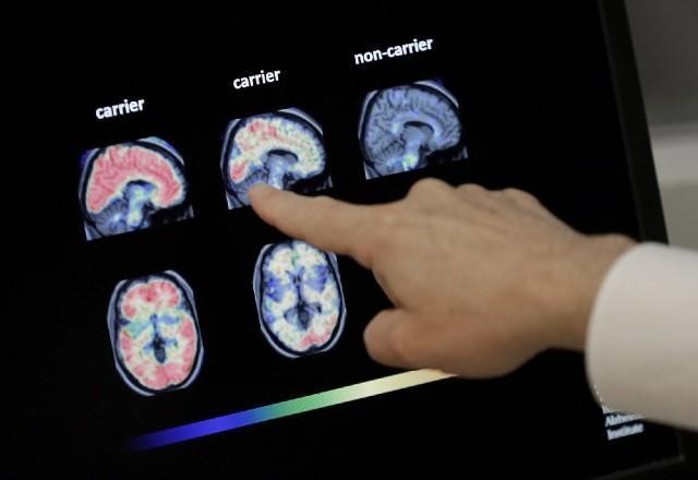 Imagem da noticia Estudo aponta que exame de sangue pode diagnosticar Alzhmeier precocemente