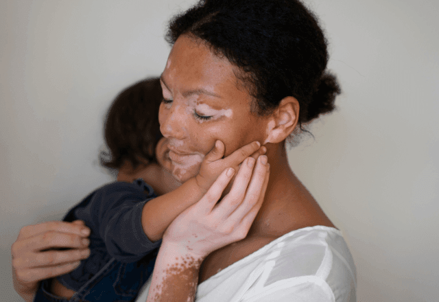 Imagem da noticia Vitiligo pode ter relação com questões emocionais (ou não); entenda