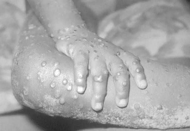 Imagem da noticia Espanha confirma segunda morte por varíola dos macacos