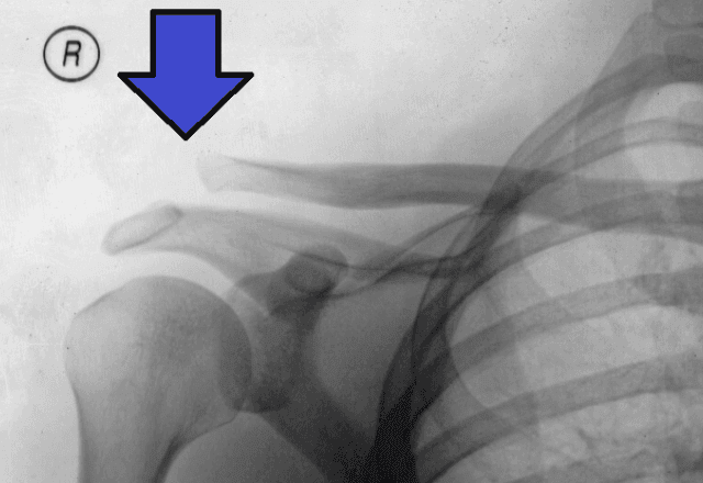 Imagem da noticia Terapia com ondas de choque vira opção para lesões em músculos e ossos