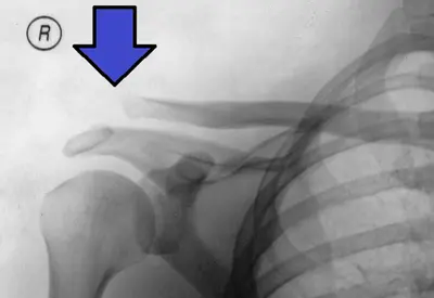 Terapia com ondas de choque vira opção para lesões em músculos e ossos Terapia com ondas de choque vira opção para lesões em músculos e ossos