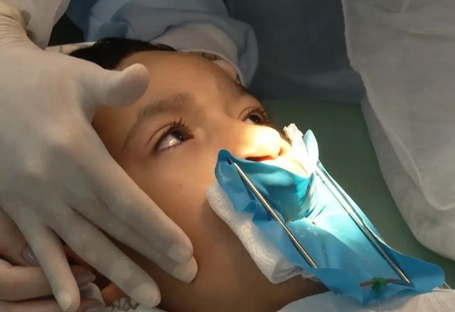 Imagem da noticia Lábio leporino: por que bebês com condição congênita precisam passar por cirurgia?