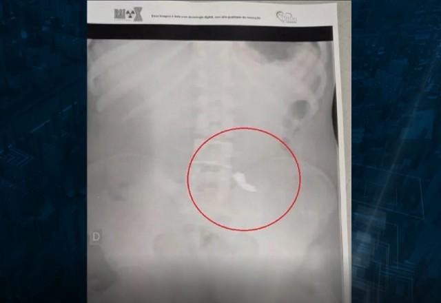Imagem da noticia Raio-X revela corrente de ouro em estômago de ladrão