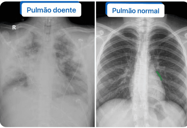 Imagem da noticia Diego, morto por Evali aos 20 anos: entenda doença causada pelo uso de cigarro eletrônico