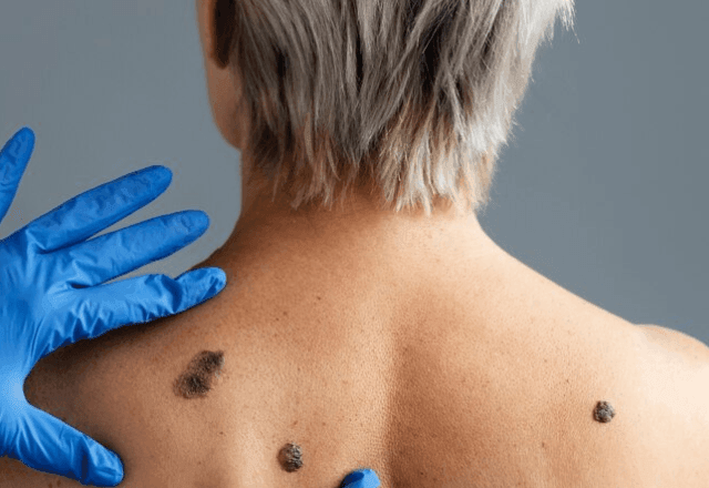 Imagem da noticia Câncer de pele: novo exame de sangue ajuda a prever volta do melanoma, diz estudo