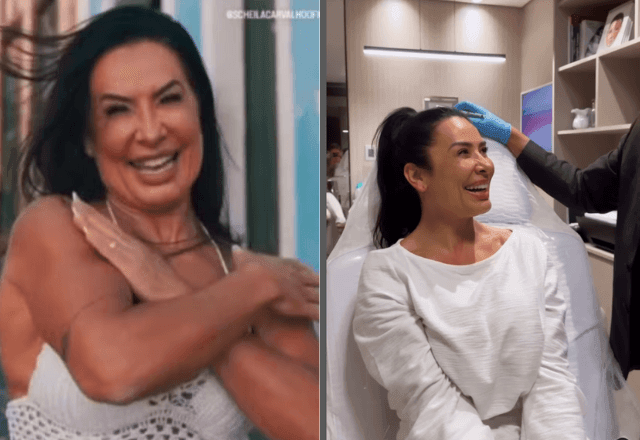 Imagem da noticia Scheila Carvalho remove preenchimento com ácido hialurônico do rosto; como funciona?