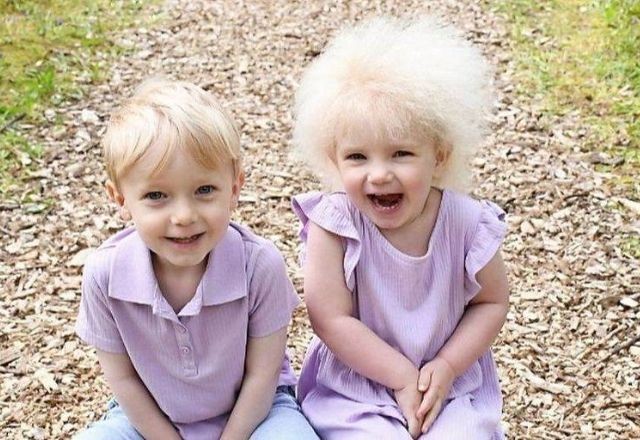 Imagem da noticia Síndrome dos cabelos impenteáveis: condição rara afeta couro cabeludo; entenda