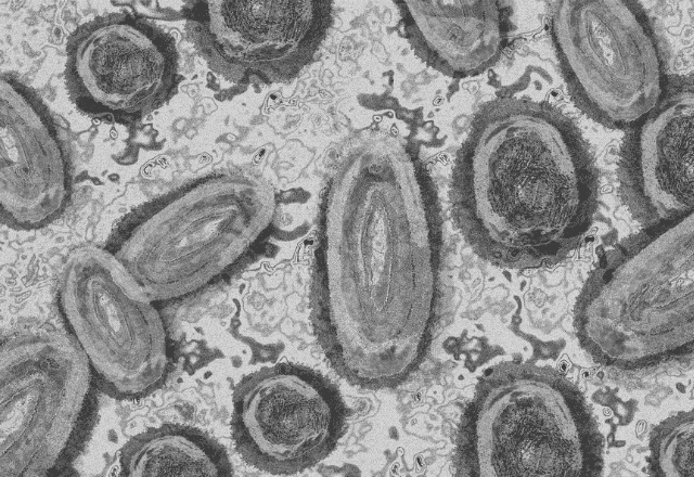 Imagem da noticia Passageiro em Guarulhos com suspeita de Mpox está com catapora; é possível diferenciar?