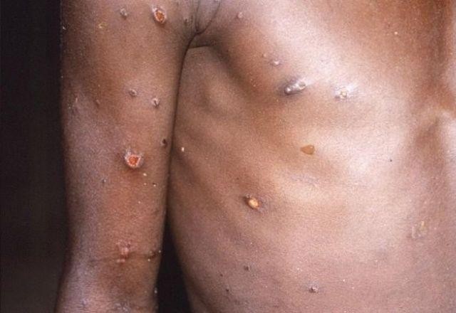 Imagem da noticia Saúde confirma 106 casos de varíola dos macacos no Brasil