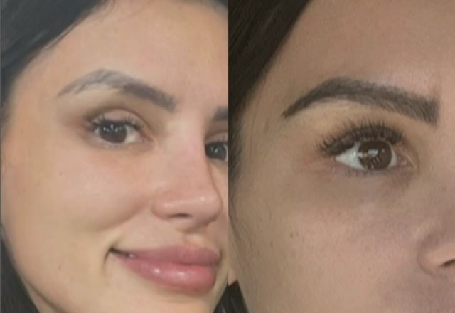 Imagem da noticia Transplante de sobrancelha: como funciona procedimento feito por Gabriela Cabrini?