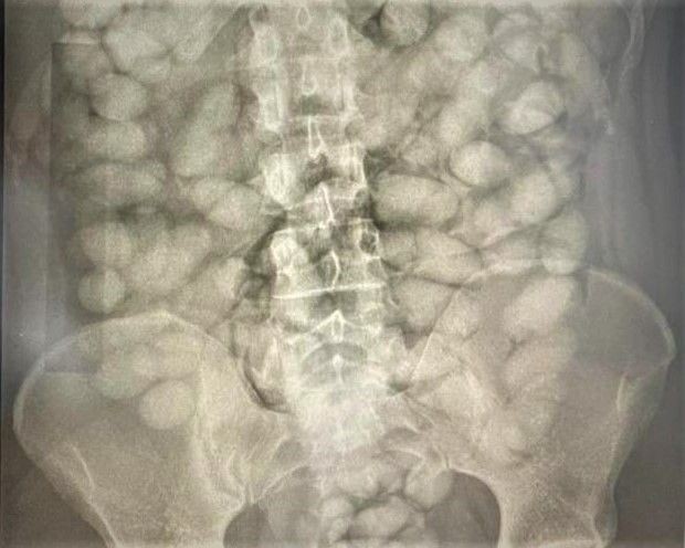 Imagem da noticia PF prende dois homens que tentavam embarcar para a França com cápsulas de cocaína no estômago