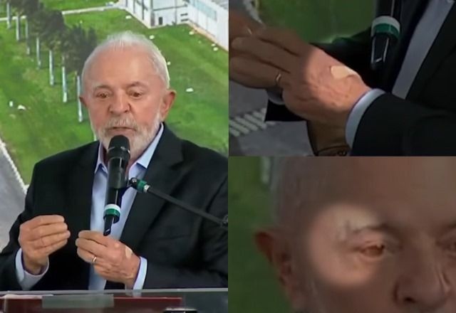 Imagem da noticia Lula aparece com curativo no rosto após procedimento médico