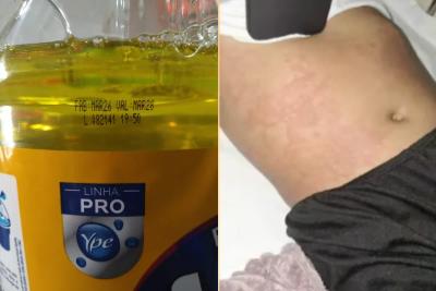 Lote contaminado da Ypê: menina é internada no RN com suspeita de intoxicação após uso de detergente Lote contaminado da Ypê: menina é internada no RN com suspeita de intoxicação após uso de detergente