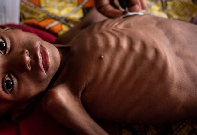 Imagem da noticia Unicef faz alerta para 10 milhões de crianças em desnutrição severa