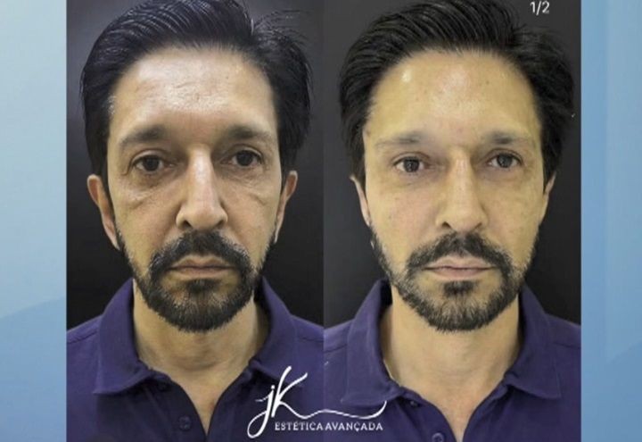 Imagem da noticia Harmonização facial de Ricardo Nunes (MDB) pode motivar investigação