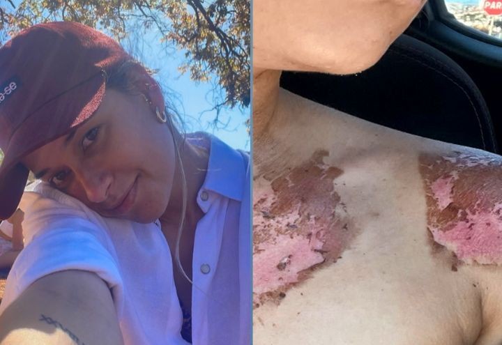 Imagem da noticia Radiador explode e água deixa queimaduras de 2º grau em jovem