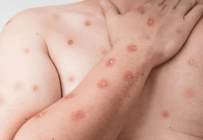 Mpox no Brasil: entenda o que é a doença e se há risco de novo surto Mpox no Brasil: entenda o que é a doença e se há risco de novo surto