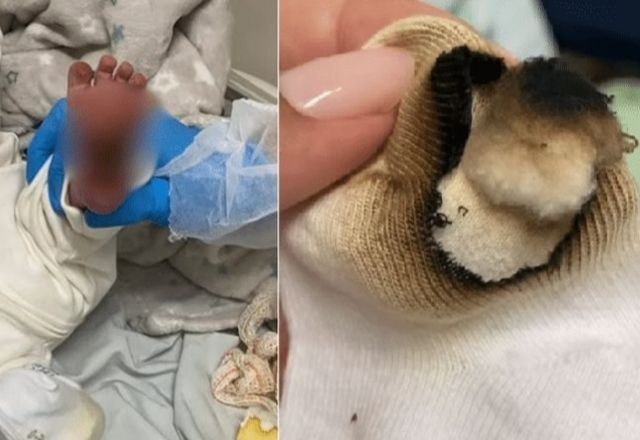 Imagem da noticia Recém-nascido sofre queimadura no pé em hospital público do ES