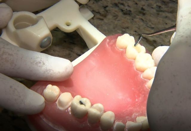 Imagem da noticia Brasil deixará de usar amálgama em restaurações dentárias até 2030