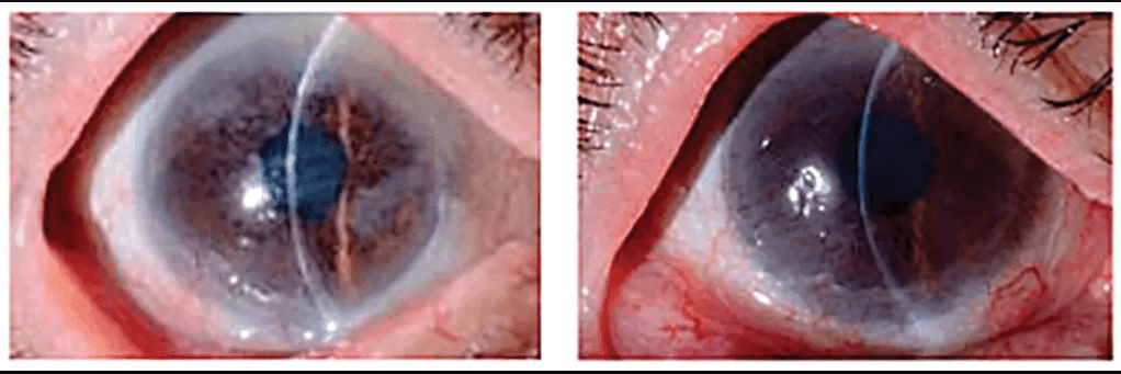 Imagem da noticia Novo tratamento com células-tronco desenvolvido no Japão promete reverter cegueira por danos nas córneas